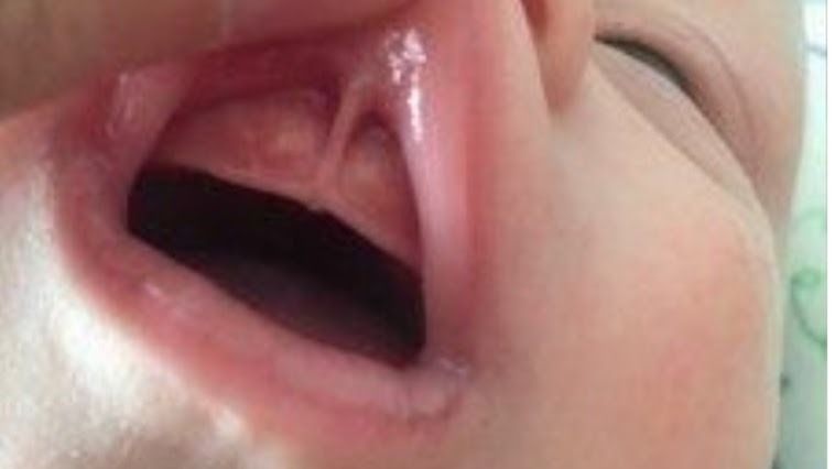 Frein de lèvre supérieur nourrisson diagnostic Fribourg