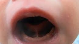 Anatomie et diagnostic du frein lingual chez le bébé, Suisse romande