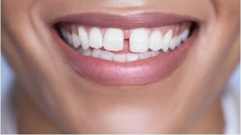 Conséquences du frein de lèvre sur l'allaitement maternel, Suisse romande