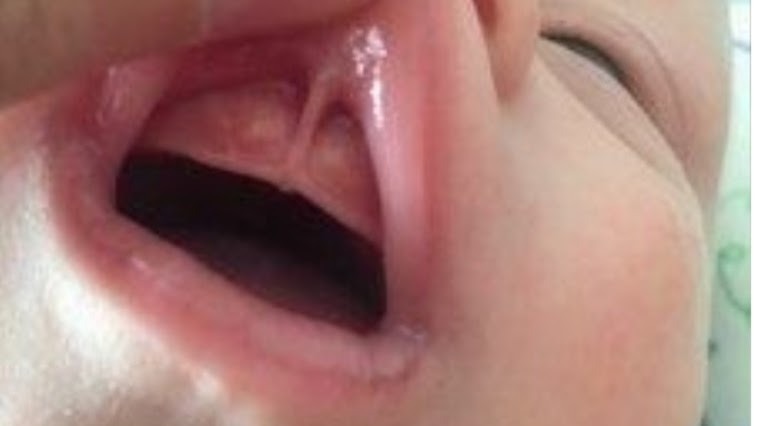 Frein de lèvre supérieur chez le bébé, diagnostic Suisse romande